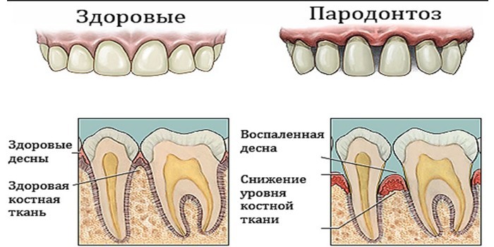 Здоровые зубы и пародонтоз