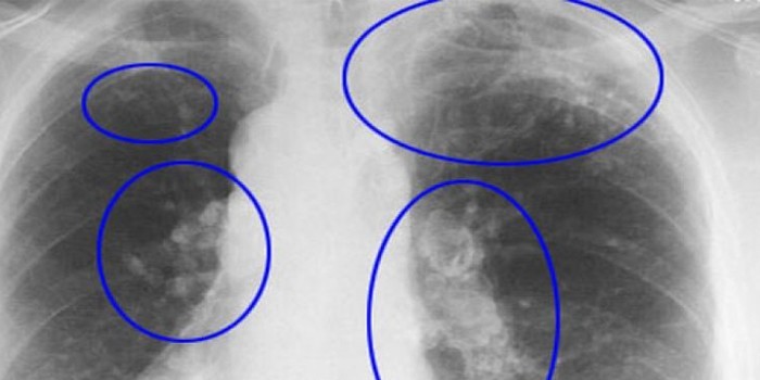 Признаки заболевания на рентгене