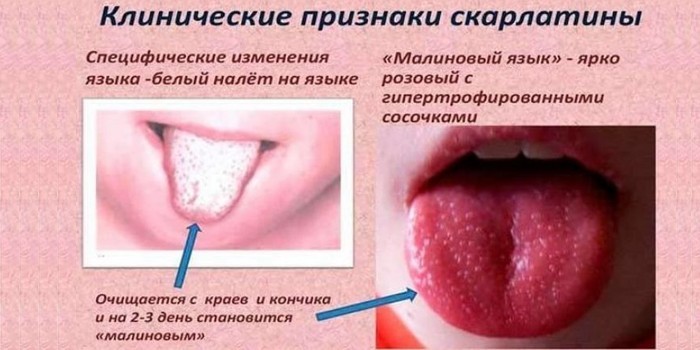 Цвет языка при скарлатине