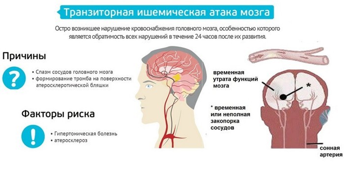 Транзиторная ишемическая атака головного мозга