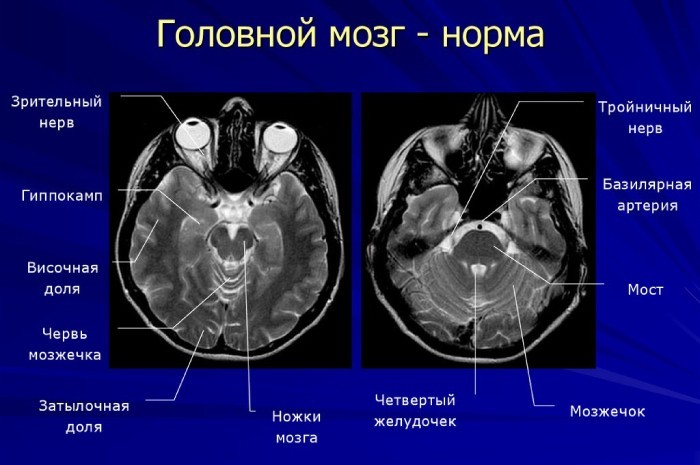 Мозг человека на снимке при МРТ