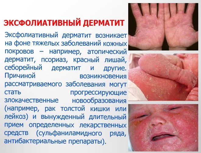 Причины эксфолиативного дерматита