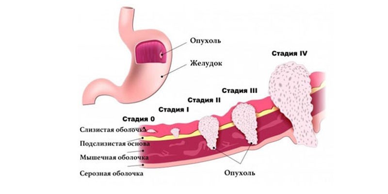 Стадии тубулярной аденокарциномы желудка
