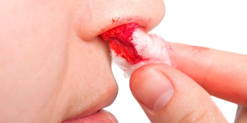 Кровотечение из носа у женщины