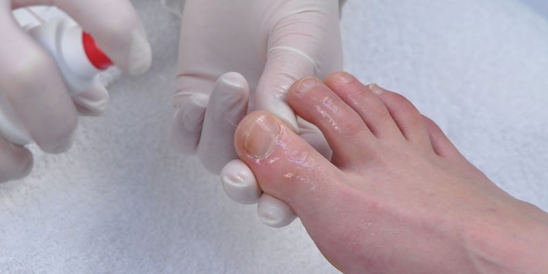 Обработка ногтей на ногах противогрибковым спреем
