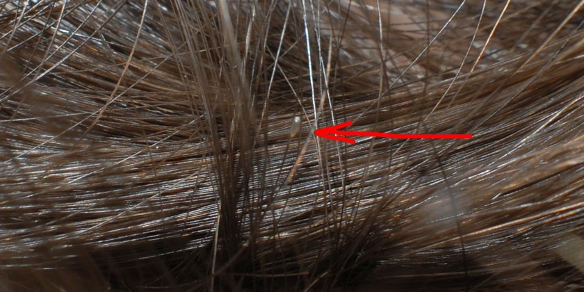 Яйца вшей в волосистой части головы