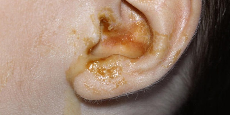 Выделение гноя из ушного канала