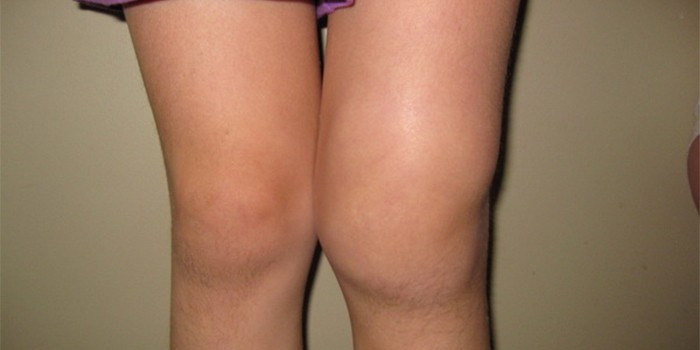 Воспаление коленного сустава