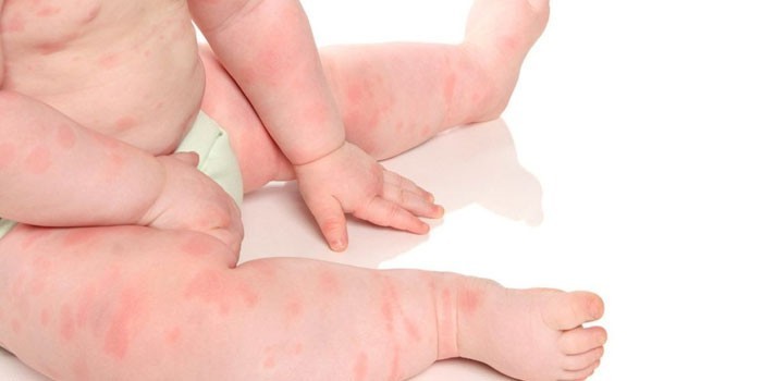 Проявление аллергической реакции на коже ребенка