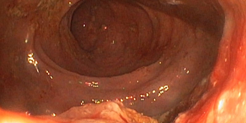 Стеноз слизистой кишечника