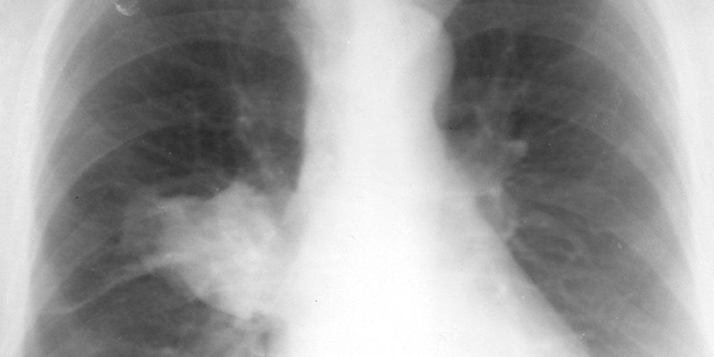 Процесс абсцедирования легочной ткани на рентгеновском снимке