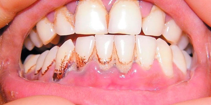 Зубной камень и начало пародонтоза 