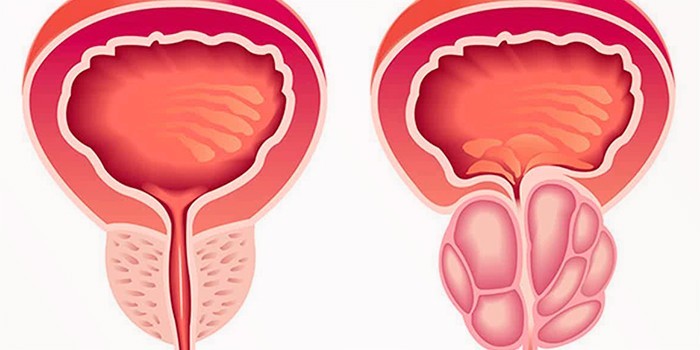 Нормальная простата и аденома