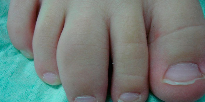 Артрит суставов пальцев на ногах