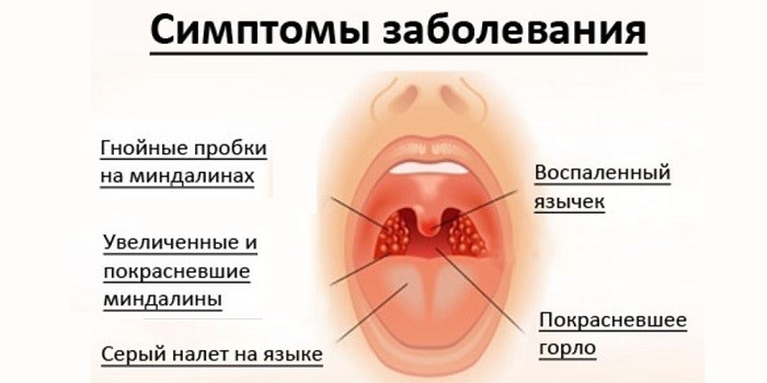 Симптомы ангины