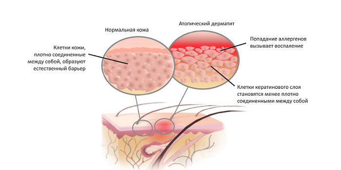 Нормальная кожа и при атопическом дерматите