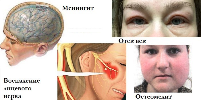 Менингит, отек век, воспаление лицевого нерва и остеомиелит