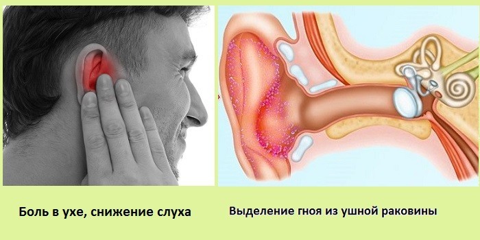 Боль в ухе и выделение гноя