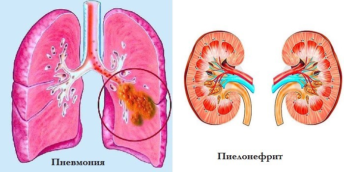 Пневмония и пиелонефрит
