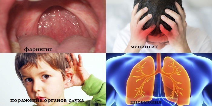 Фарингит, менингит, пневмония и болезни органов слуха