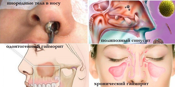Однородные тела в носу, полипозный синусит, одонтогенный и хронический гайморит