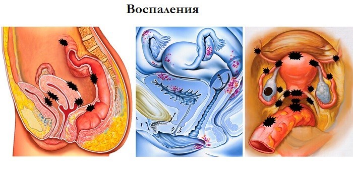 Локализация эндометрия вне матки