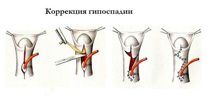 Этапы хирургической коррекции