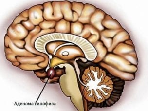 Аденома гипофиза : симптомы и лечение опухоли головного мозга