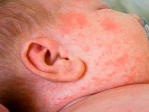 Аллергическая сыпь у детей - причины, симптомы и лечение