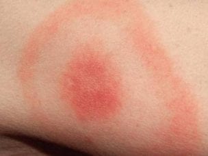 Аллергия на укусы насекомых - симптомы, проявления, первая помощь