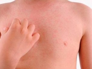 Аллергия на витамин B у детей и взрослых - характерные проявления и лечение