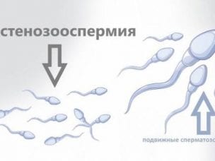 Астенозооспермия: причины, степени и лечение патологии
