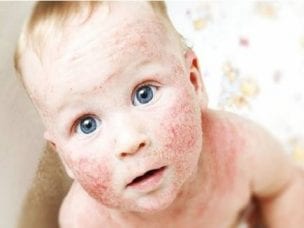 Атопический дерматит у детей и взрослых - причины, симптомы и лечение
