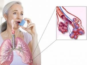 Бронхиальная астма - причины возникновения, симптомы и методы лечения