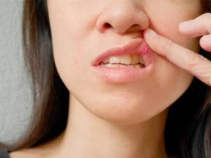 Чем лечить язвочки во рту