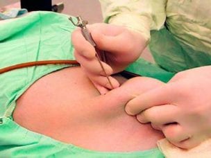 Диагностическая лапароскопия брюшной полости - показания к проведению