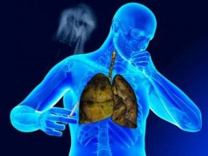 Диссеминированный туберкулез легких: симптомы и лечение