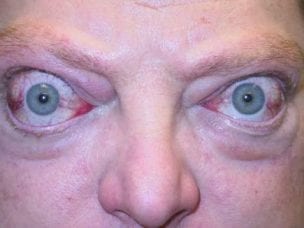 Эндокринная офтальмопатия – симптомы и классификация