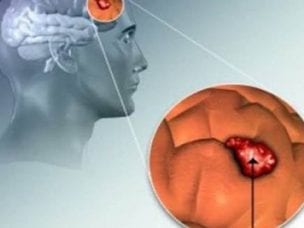 Глиобластома головного мозга - симптомы, стадии и лечение