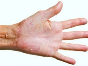 Самые распространенные грибковые заболевания кожи и их лечение