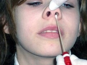 Как лечить стафилококк в носу