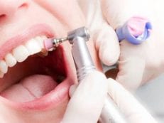Камни на зубах: как удалить и от чего образовываются