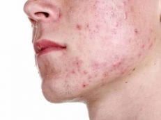 Кандидоз кожи — первые признаки и лечение
