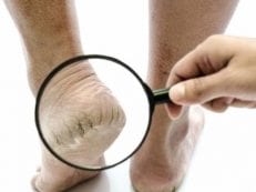 Крем для пяток от трещин — список эффективных лекарственных средств для смягчения кожи стоп