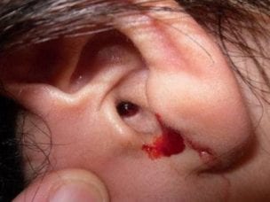 Кровянистые выделения из уха - причины возникновения, диагностика и методы лечения