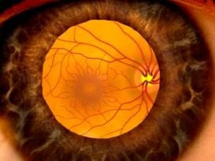 Лечение макулярной дистрофии сетчатки глаза медикаментами и народными средствами