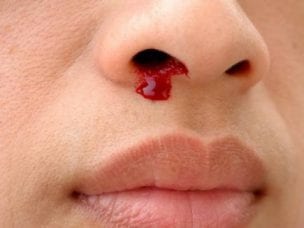 Лечение носовых кровотечений у взрослых и детей