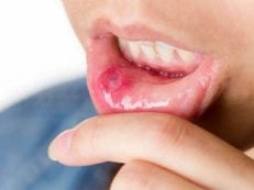 Лекарство от стоматита во рту у взрослых: чем лечить воспаления и язвы