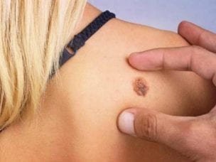 Меланома кожи - признаки, стадии, лечение и удаление