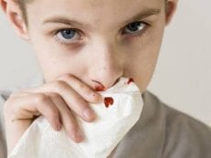 Носовые кровотечения у детей – причины появления